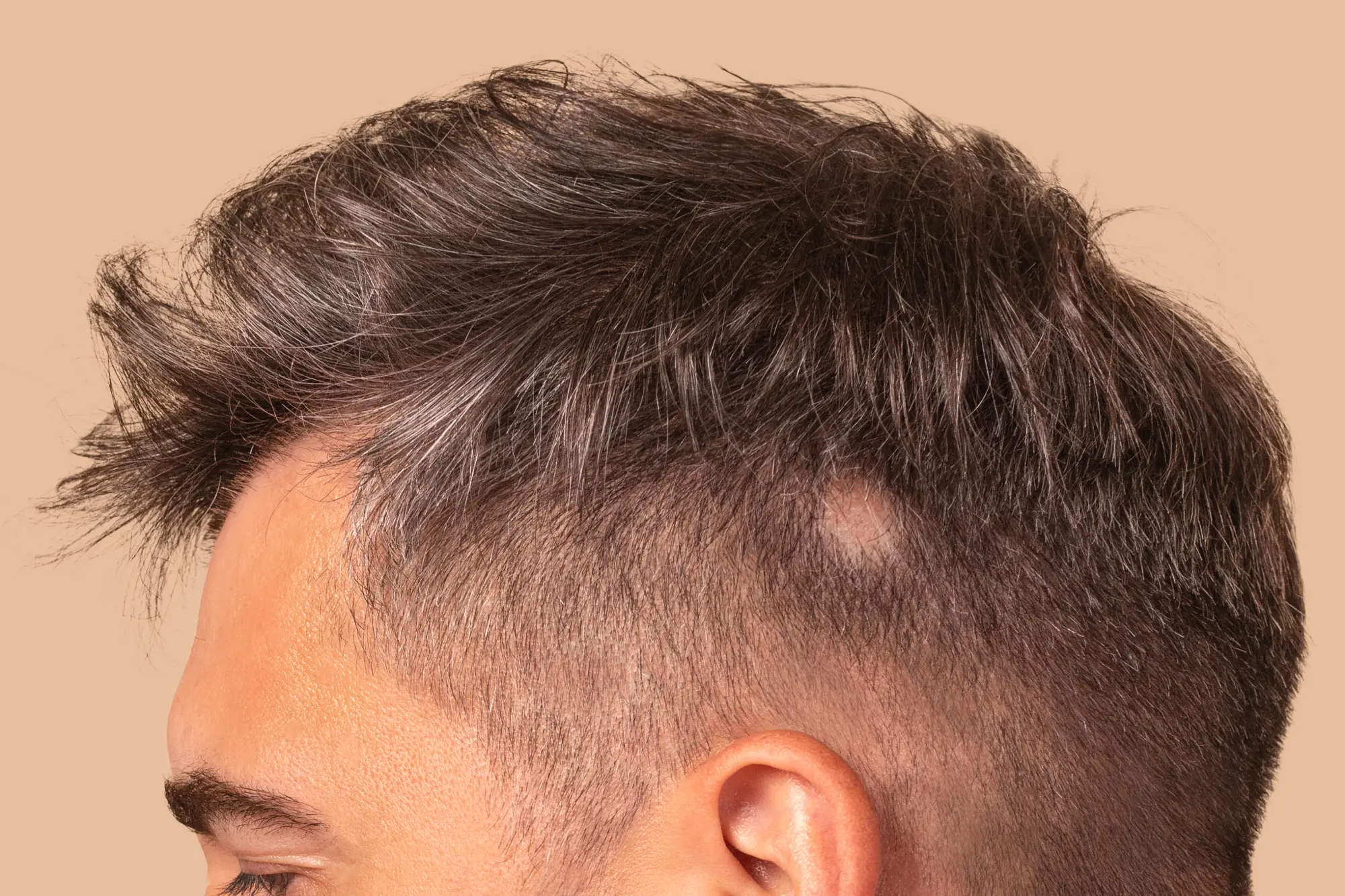 An example of Alopecia Areata
